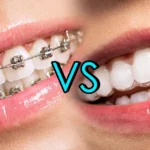 Clear Braces vs Clear Aligners: Which Is Easier to Live With