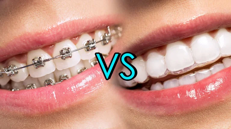 Clear Braces vs Clear Aligners: Which Is Easier to Live With